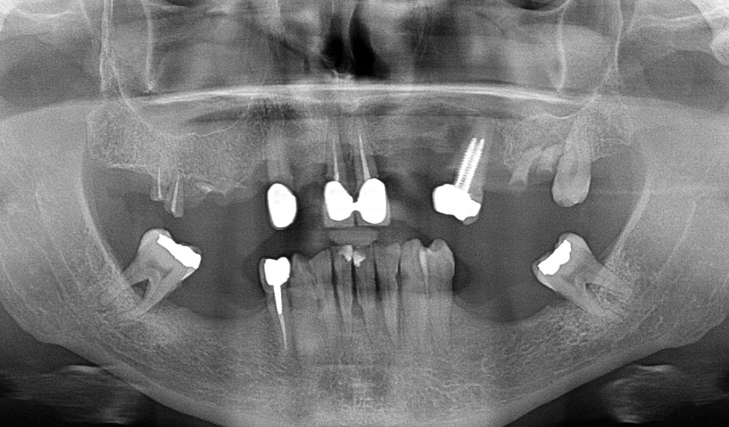 caso real de implantes dentales