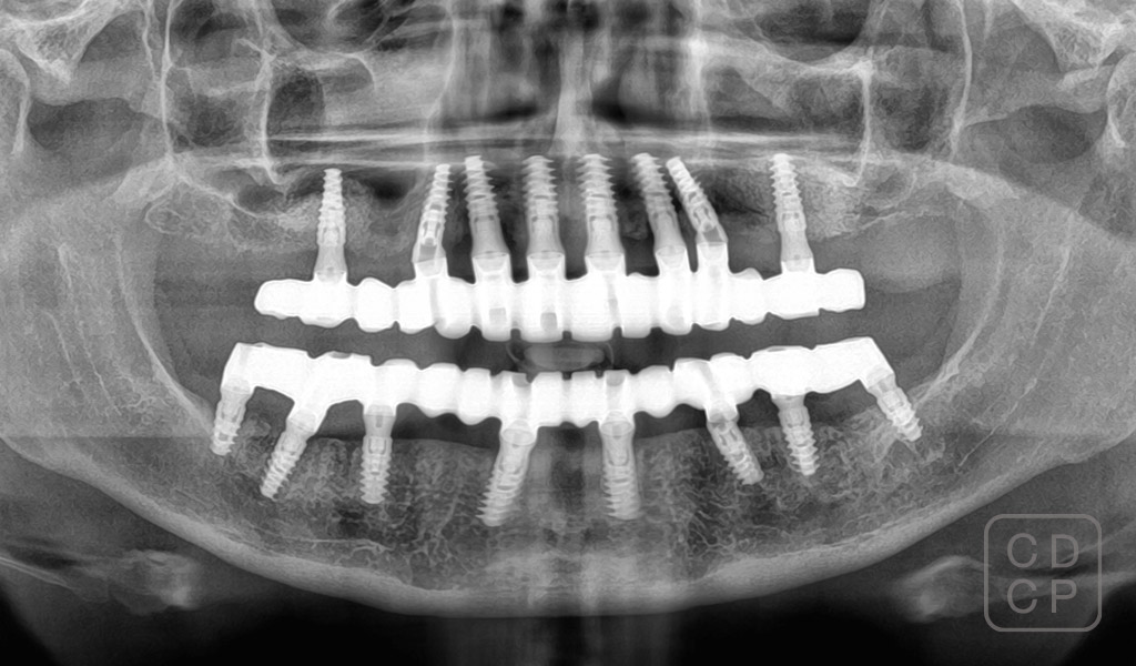 cas real d'implants dentals