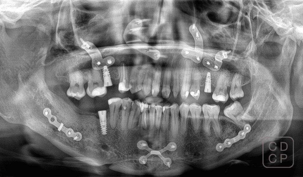 cas real de rehabilitació dental