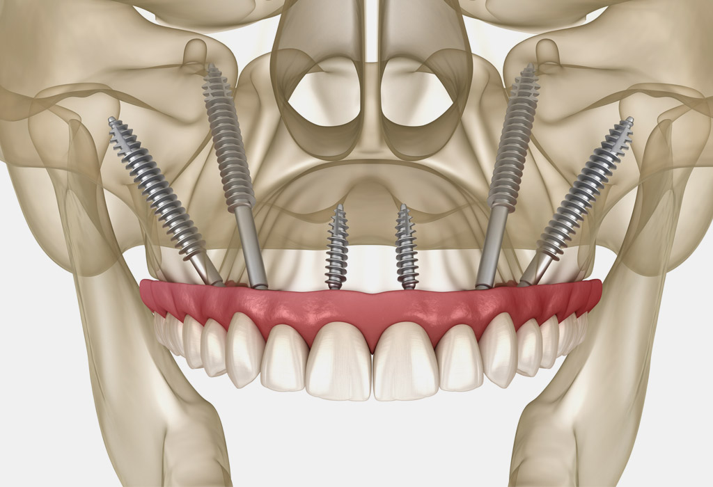 implants zigomàtics a Terrassa